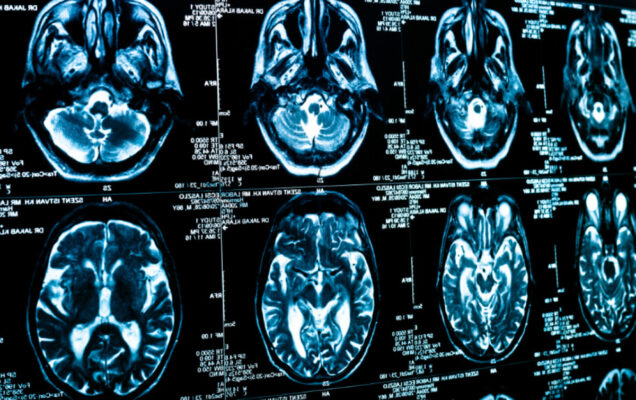 Use of MRI in Detecting Infectious and Inflammatory Diseases - ILFC